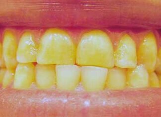 दांतो में पीलापन व् शरीर की हड्डियों में टेढ़ापन है तो इस बीमारी से हो जाइए सावधान दांतो में पीलापन व् शरीर की हड्डियों में टेढ़ापन है तो इस बीमारी से हो जाइए सावधान