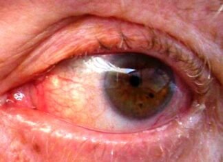 विश्व ग्लाकोमा सप्ताह 06 से 12 मार्च तक किया जाएगा आयोजित विश्व ग्लाकोमा सप्ताह 06 से 12 मार्च तक किया जाएगा आयोजित