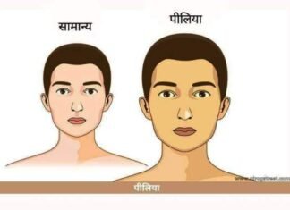 पीलिया रोग के बारे में जानिए यह कैसे और क्यों होता है पीलिया रोग के बारे में जानिए यह कैसे और क्यों होता है